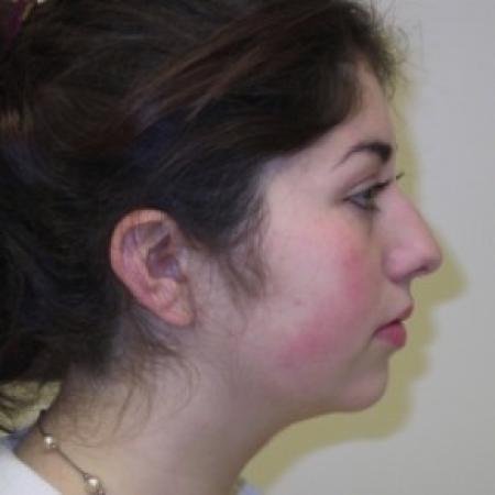 Before image 2 Case #81246 - Rhinoplasty