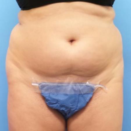 Before image 1 Case #86656 - Liposuction of Abdomen, Waist & Flanks - 3 months post-op