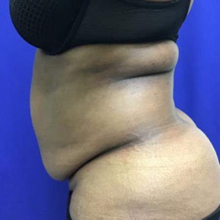 Before image 3 Case #88281 - Tummy Tuck and Liposuction
