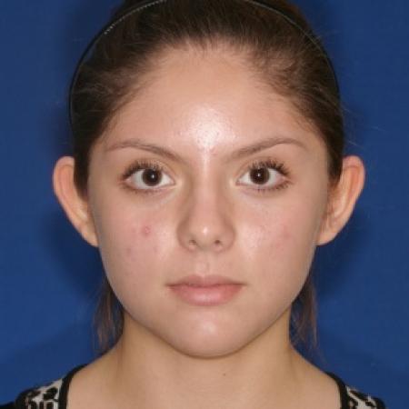 Before image 1 Case #79941 - Otoplasty Ear surgery