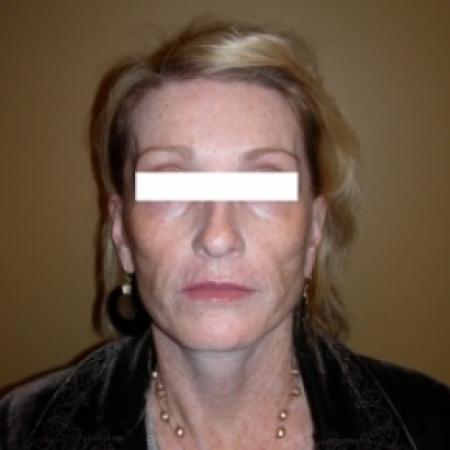 Before image 1 Case #79801 - Sculptra