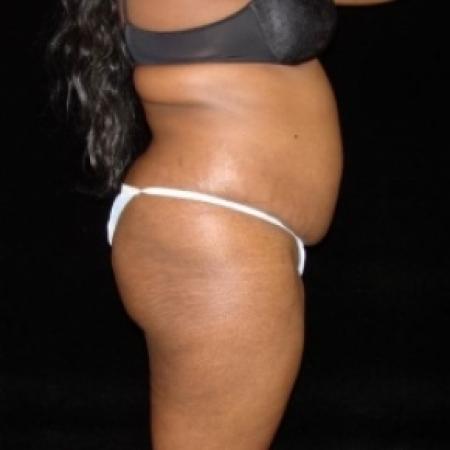 Before image 3 Case #80486 - Buttocks Augmentation Via Fat Grafting with Liposuction of Abdomen, Waist, Flanks, and Dorsal Roll