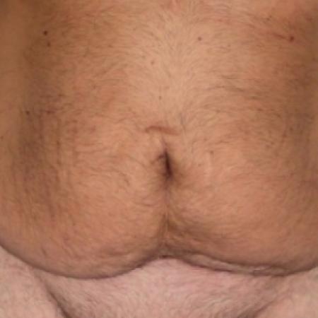 Before image 1 Case #79796 - Male Tummy Tuck
