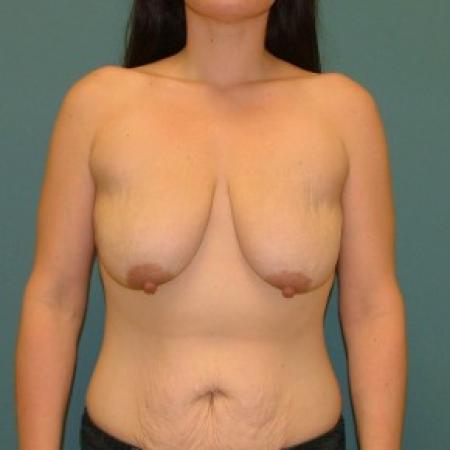 Before image 1 Case #86741 - Mastopexy+ Breast Augmentation