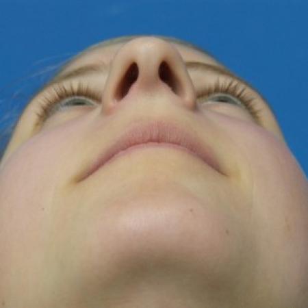 Before image 4 Case #87221 - 18 year old - Rhinoplasty/Septoplasty/Turbinectomy  -  5 months post-op