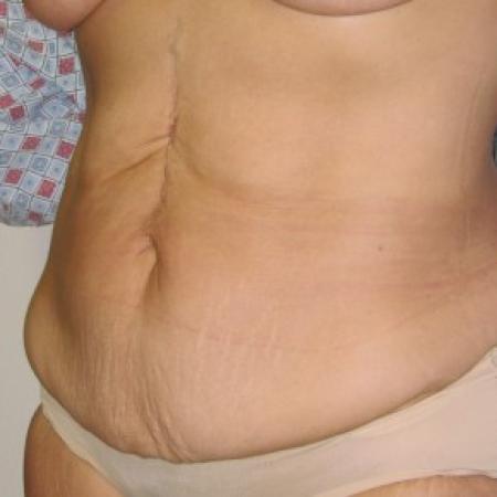 Before image 2 Case #85806 - Massive weight loss patient with Fleur-de-Lis abdominoplasty