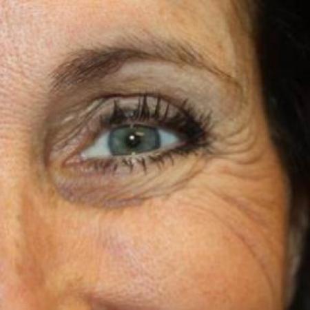 Before image 2 Case #85301 - Botox (Glabella & Crows Feet) - 54 year old female.