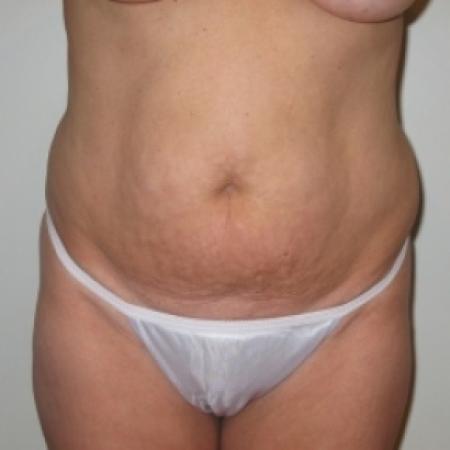 Before image 1 Case #79921 - Tummy Tuck 