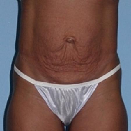 Before image 1 Case #79146 - Tummy Tuck
