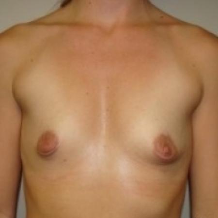 Before image 1 Case #79461 - Breast Augmentation
