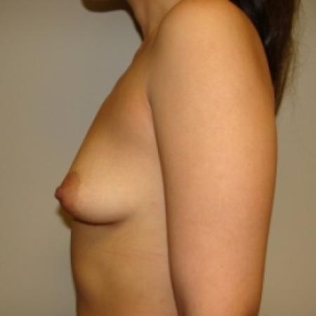 Before image 5 Case #80076 - Breast Augmentation
