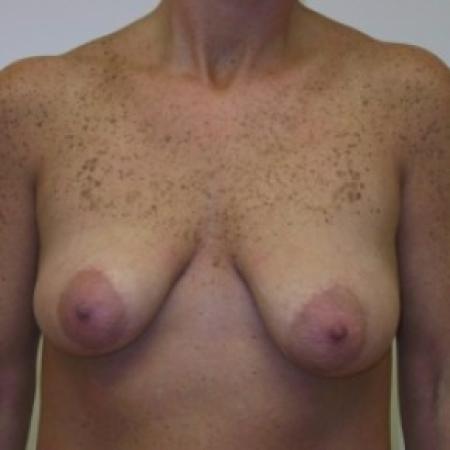 Before image 1 Case #81116 - Breast Lift with Saline Filled Implants