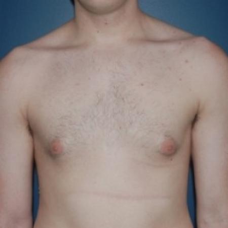 Before image 1 Case #81231 - Bilateral gynecomastia