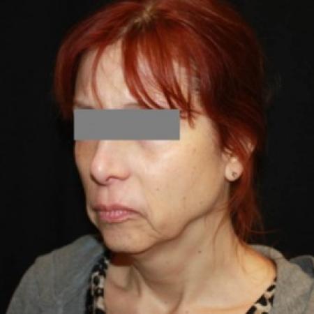 Before image 2 Case #84386 - Facelift/Facial Rejuvenation - 54 year old female