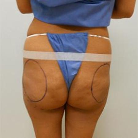 Before image 2 Case #84911 - Buttock Augmenation with implants and liposuction of the abdomen