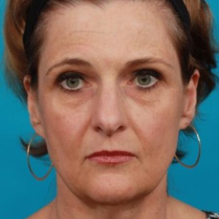 Before image 1 Case #86596 - Full Facial Rejuvenation