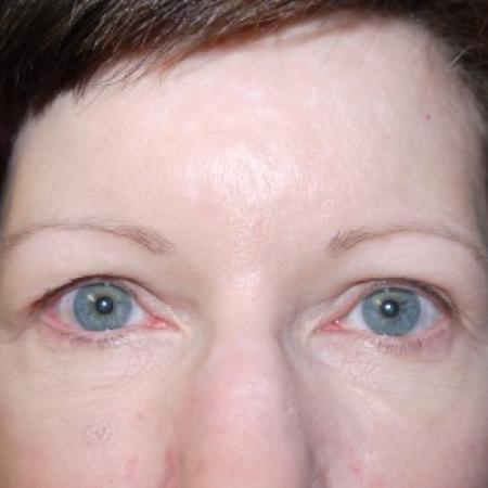 Before image 1 Case #82466 - 55 year old 2 years after Endoscopic Brow Lift and Upper Blepharoplasty