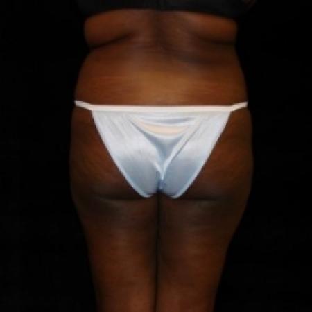 Before image 5 Case #80486 - Buttocks Augmentation Via Fat Grafting with Liposuction of Abdomen, Waist, Flanks, and Dorsal Roll