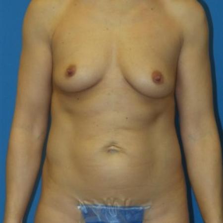 Before image 1 Case #86441 - Submuscular Breast Augmentation 420cc Shaped Moderate Projection Silicone Gel Implants