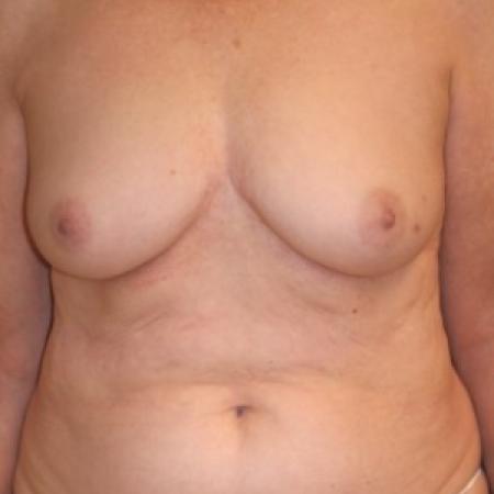 Before image 1 Case #84946 - 72 y/o - Immediate Left DIEP Breast Flap Reconstruction