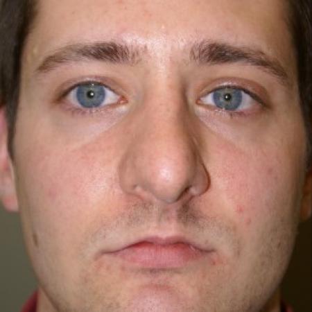 Before image 1 Case #81896 - Open Structure Septorhinoplasty and Sub-Mucous Resection
