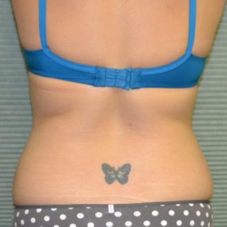 Before image 3 Case #87836 - Tummy Tuck and liposuction of flanks