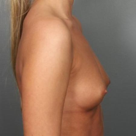 Before image 2 Case #83436 - Breast Augmentation with Submuscular Round Silicone Implants