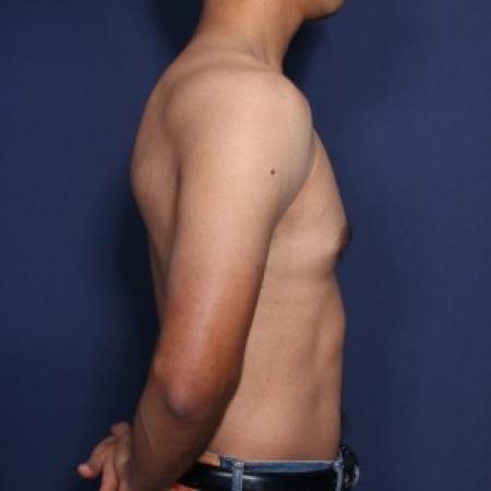 Before image 2 Case #83856 - 30 Years Old Male 