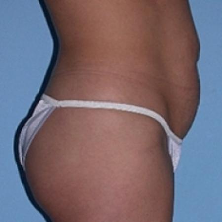 Before image 2 Case #79151 - Tummy Tuck