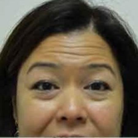 Before image 1 Case #85766 - Botox 