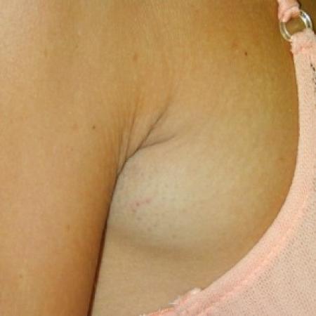 Before image 2 Case #82226 - Excised Lipoma