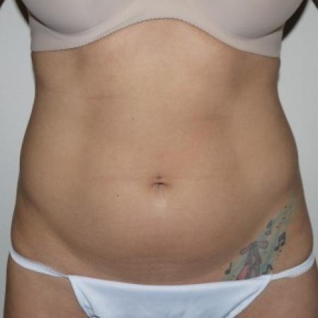 Before image 1 Case #82561 - Liposuction of the abdomen and hips