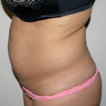 Before image 2 Case #82386 - Abdominoplasty