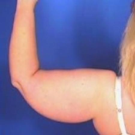 Before image 1 Case #79181 - Liposuction