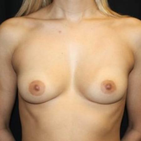 Before image 1 Case #85101 - Breast Augmentation - 36 year old female