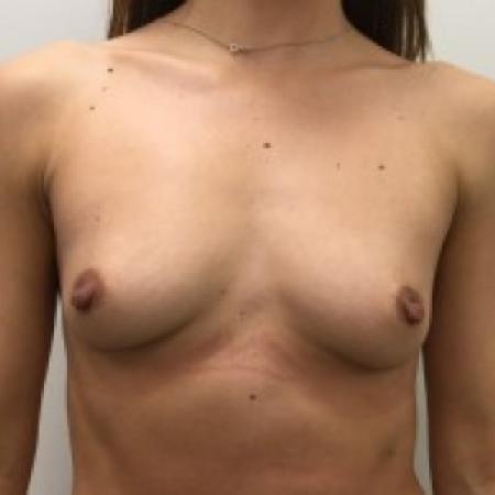 Before image 1 Case #87206 - Breast Augmentation