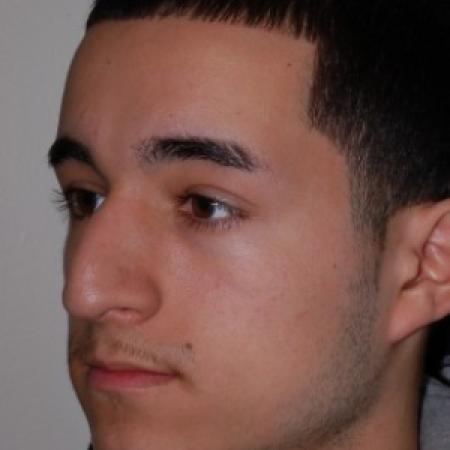 Before image 1 Case #87211 - Rhinoplasty