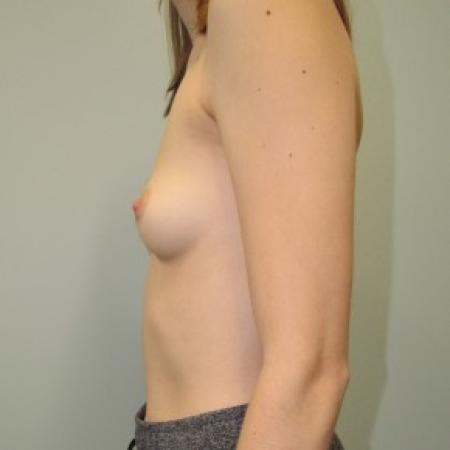 Before image 2 Case #87346 - Breast Augmentation in 22 year-old