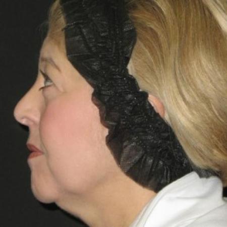 Before image 2 Case #82696 - 53 Year Old Woman's Facial Rejuvenation