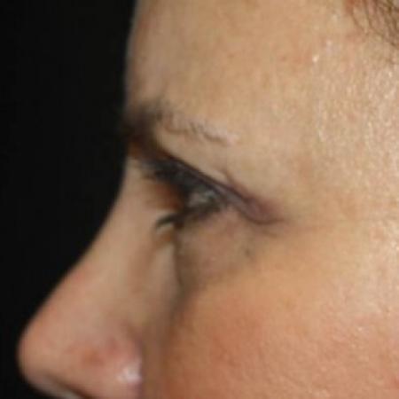 Before image 3 Case #84271 - Brow Lift- 60 year old female