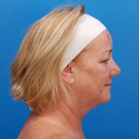Before image 2 Case #85331 - 61 y/o woman after Laser Liposuction to the neck, skin tightening, eyelid surgery, & fat grafting to the face