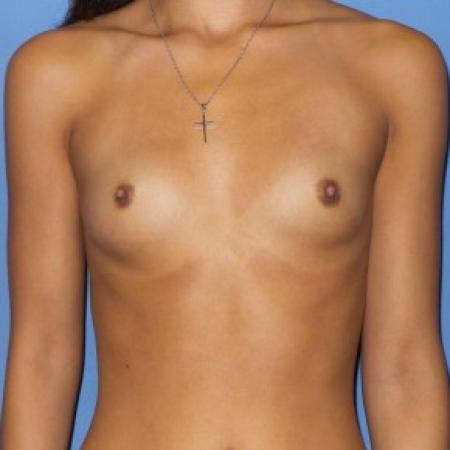Before image 1 Case #84276 - 23 y/o female with breast augmentation