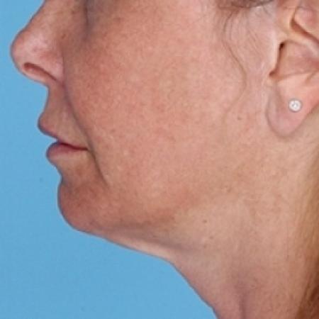 Before image 2 Case #79326 - Non-Surgical Focused Ultrasound