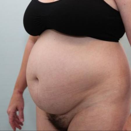 Before image 2 Case #86546 - BAND Abdominoplasty