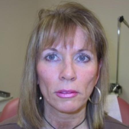 Before image 1 Case #81146 - Cheek injections using Radiesse