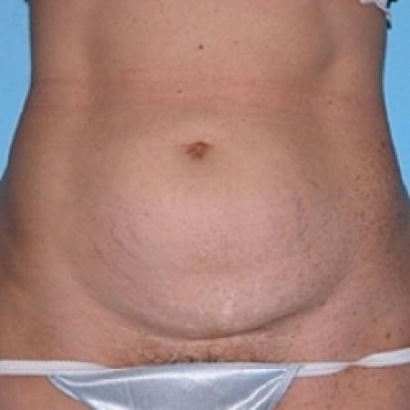 Before image 1 Case #79156 - Tummy Tuck