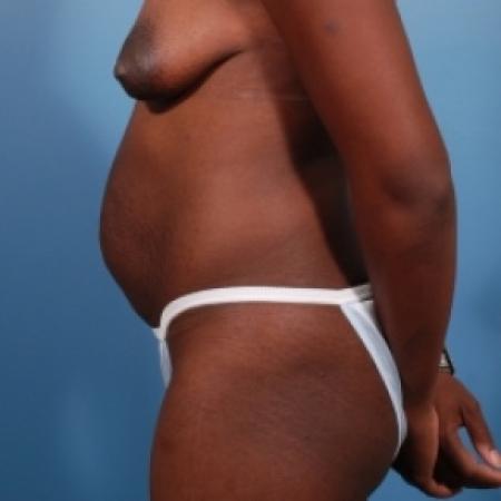 Before image 3 Case #78871 - Abdominoplasty