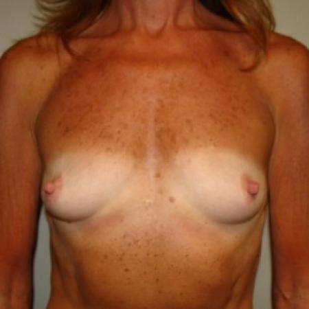 Before image 1 Case #80061 - Breast Augmentation