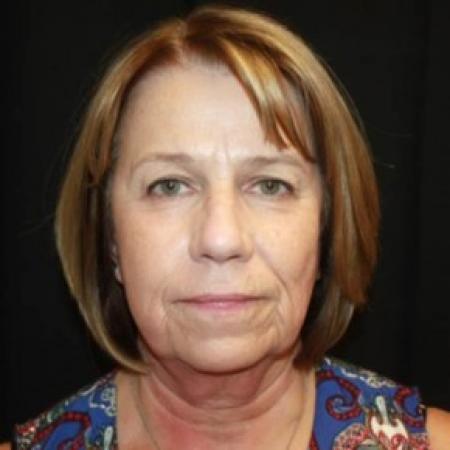 Before image 1 Case #85231 - Facelift/Facial Rejuvenation - 64 year old female