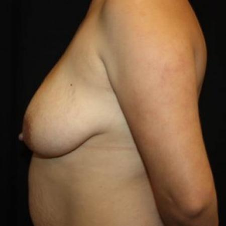 Before image 3 Case #85166 - Breast Lift - 27 year old female